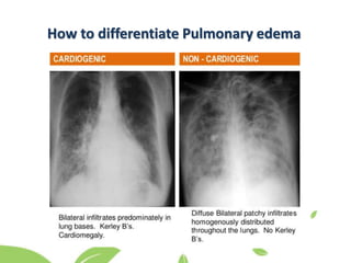 How to differentiate Pulmonary edema
 