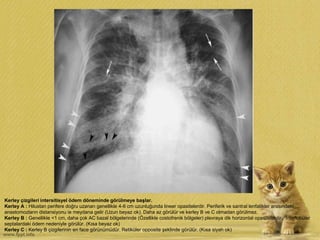 Kerley çizgileri intersitisyel ödem döneminde görülmeye başlar.
Kerley A : Hilustan perifere doğru uzanan genellikle 4-6 cm uzunluğunda lineer opasitelerdir. Periferik ve santral lenfatikler arasındaki
anastomozların distansiyonu ie meydana gelir (Uzun beyaz ok). Daha az görülür ve kerley B ve C olmadan görülmez.
Kerley B : Genellikle <1 cm, daha çok AC bazal bölgelerinde (Özellikle costofrenik bölgeler) plevraya dik horizontal opasitelerdir. İnterlobüler
septalardaki ödem nedeniyle görülür. (Kısa beyaz ok)
Kerley C : Kerley B çizgilerinin en face görünümüdür. Retiküler opposite şeklinde görülür. (Kısa siyah ok)
 