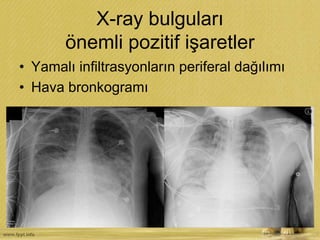 X-ray bulguları
önemli pozitif işaretler
• Yamalı infiltrasyonların periferal dağılımı
• Hava bronkogramı
 
