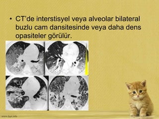 • CT’de interstisyel veya alveolar bilateral
buzlu cam dansitesinde veya daha dens
opasiteler görülür.
 