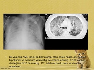 • 65 yaşında AML tanısı ile kemoterapi alan erkek hasta, ani gelişen
hipoksemi ve solunum yetmezliği ile entübe edilmiş. %100 oksijen
desteği ile PO2 54 mmHg . CT bilateral buzlu cam ve alveoler
opasiteler
 