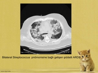 Bilateral Streptococcus pnömonisine bağlı gelişen şiddetli ARDS
 