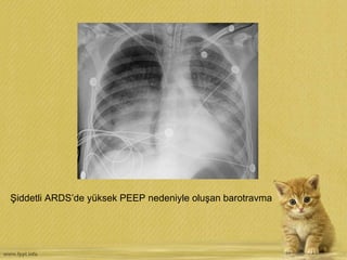 Şiddetli ARDS’de yüksek PEEP nedeniyle oluşan barotravma
 