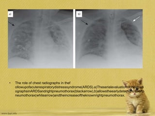 • The role of chest radiographs in thef
ollowupofacuterespiratorydistresssyndrome(ARDS).a)Theserialevaluationofchestradi
ographsinARDSandrightpneumothorax(blackarrow),b)allowstheearlydetectionofaleftp
neumothorax(whitearrow)andtheincreaseoftheknownrightpneumothorax.
 