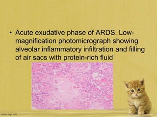 • Acute exudative phase of ARDS. Low-
magnification photomicrograph showing
alveolar inflammatory infiltration and filling
of air sacs with protein-rich fluid
 