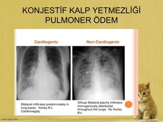 KONJESTİF KALP YETMEZLİĞİ
PULMONER ÖDEM
 