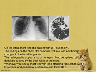 On the left a chest film of a patient with UIP due to IPF.
The findings on the chest film comprise volume loss and fibrotic
changes in the basal lung area.
The radiographic appearance of honeycombing comprises reticular
densities caused by the thick walls of the cysts.
Whenever you see a chest film with long standing reticulation with a
lower lobe and peripheral preference also think 'UIP'.
 