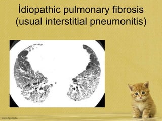 İdiopathic pulmonary fibrosis
(usual interstitial pneumonitis)
 