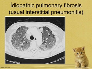 İdiopathic pulmonary fibrosis
(usual interstitial pneumonitis)
 