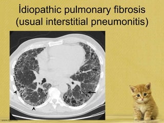 İdiopathic pulmonary fibrosis
(usual interstitial pneumonitis)
 