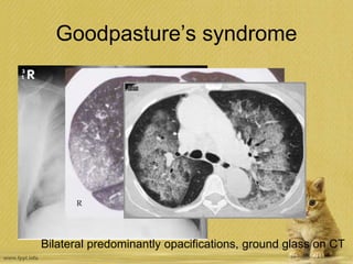 Goodpasture’s syndrome
Bilateral predominantly opacifications, ground glass on CT
 