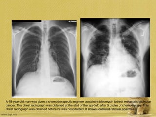 A 48-year-old man was given a chemotherapeutic regimen containing bleomycin to treat metastatic testicular
cancer. This chest radiograph was obtained at the start of therapy(left) after 5 cycles of chemotherapy. This
chest radiograph was obtained before he was hospitalized. It shows scattered reticular opacities.
 