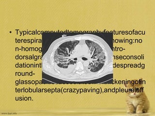 • Typicalcomputedtomographyfeaturesofacu
terespiratorydistresssyndromeshowing:no
n-homogeneousdistribution,aventro-
dorsalgradientofdensity,moredenseconsoli
dationinthedependentregions,widespreadg
round-
glassopacitiesassociatedwiththickeningofin
terlobularsepta(crazypaving),andpleuraleff
usion.
 