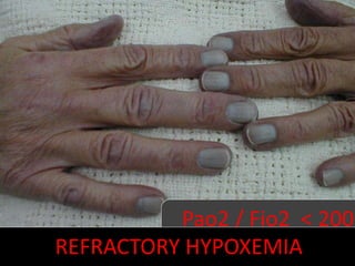 Cyanosis
Pao2 / Fio2 < 200
REFRACTORY HYPOXEMIA
 