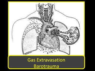 Gas Extravasation
Barotrauma
 