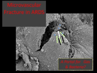1 
A Portal for Gas
& Bacteria?
Microvascular
Fracture in ARDS
 