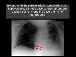Excessive PEEP, particularly in combination with
hypovolemia, can decrease cardiac output and
oxygen delivery, and increase the risk of
barotrauma
 