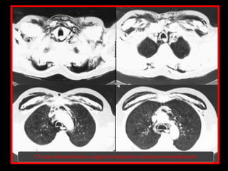 CT scan showed Severe surgical emphysema and pneumomediasteum
 