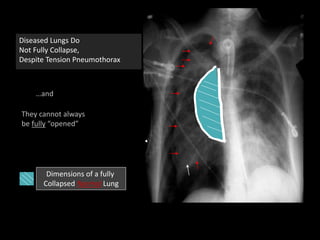 Diseased Lungs Do
Not Fully Collapse,
Despite Tension Pneumothorax
…and
They cannot always
be fully “opened”
Dimensions of a fully
Collapsed Normal Lung
 
