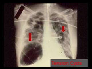 Tension Cysts
 