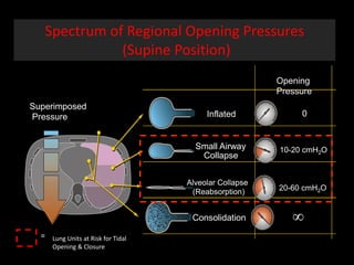 Spectrum of Regional Opening Pressures
(Supine Position)
Superimposed
Pressure Inflated 0
Alveolar Collapse
(Reabsorption) 20-60 cmH2O
Small Airway
Collapse
10-20 cmH2O
Consolidation 
Lung Units at Risk for Tidal
Opening & Closure
=
Opening
Pressure
 