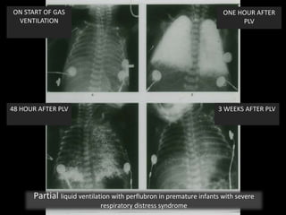 ON START OF GAS
VENTILATION
ONE HOUR AFTER
PLV
48 HOUR AFTER PLV 3 WEEKS AFTER PLV
Partial liquid ventilation with perflubron in premature infants with severe
respiratory distress syndrome
 