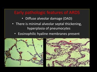 Early pathologic features of ARDS
• Diffuse alveolar damage (DAD)
• There is minimal alveolar septal thickening,
hyperplasia of pneumocytes
• Eosinophilic hyaline membranes present
 