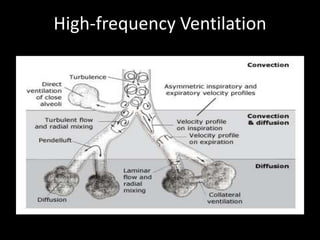 High-frequency Ventilation
 