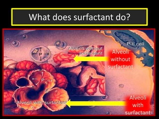 What does surfactant do?
Alveoli
without
surfactant
Alveoli
with
surfactant
 