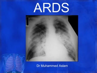 ARDS
Dr Muhammed Aslam
 