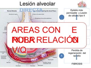 Lesión alveolar
DIRECTA
Disminuye la
producción
de
surfactante
2
Epitelio más
permeable y Lesión
de células tipo II
1
FASE AGUDA O
EXUDATIVA (0-7
días
Perdida de
regeneración del
epitelio
FIBROSIS
4
Perdida de
barrera
epitelia
l
SEPS
IS
3
AREAS CON
POBR
E
O
NULA RELACIÓN
V/Q
 
