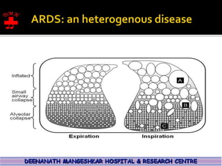 ARDS PATHO PHYSIOLOGY 1.pptx