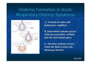 Oedema Formation in Acute
Respiratory Distress Syndrome
             A, Normal alveolus and
             pulmonary capillary

             B, Interstitial oedema occurs
             with increased flow of fluid
             into the interstitial space

             C, Alveolar oedema occurs
             when the fluid crosses the
             blood-gas barrier


                                       Fig. 66-8
 