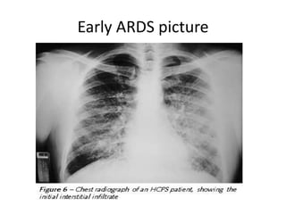 Early ARDS picture
 