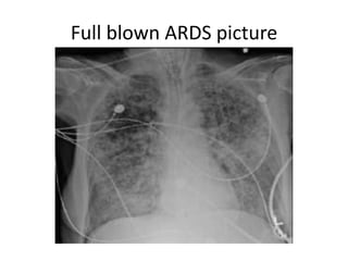 Full blown ARDS picture
 