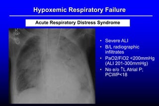 Hypoxemic Respiratory Failure
Acute Respiratory Distress Syndrome
• Severe ALI
• B/L radiographic
infiltrates
• PaO2/FiO2 <200mmHg
(ALI 201-300mmHg)
• No e/o L Atrial P;
PCWP<18
 