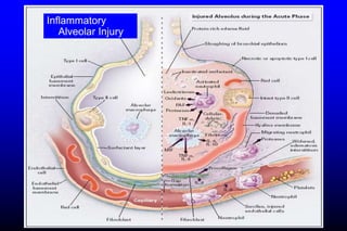 Inflammatory
Alveolar Injury
 
