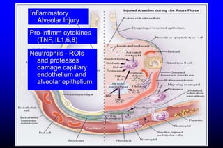Inflammatory
Alveolar Injury
Pro-inflmm cytokines
(TNF, IL1,6,8)
Neutrophils - ROIs
and proteases
damage capillary
endothelium and
alveolar epithelium
 
