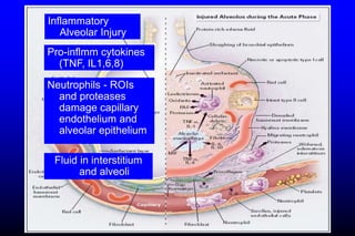 Inflammatory
Alveolar Injury
Fluid in interstitium
and alveoli
Pro-inflmm cytokines
(TNF, IL1,6,8)
Neutrophils - ROIs
and proteases
damage capillary
endothelium and
alveolar epithelium
 