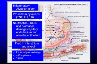 Inflammatory
Alveolar Injury
Fluid in interstitium
and alveoli
• Impaired gas exchange
•  Compliance
•  PAP
Pro-inflmm cytokines
(TNF, IL1,6,8)
Neutrophils - ROIs
and proteases
damage capillary
endothelium and
alveolar epithelium
 