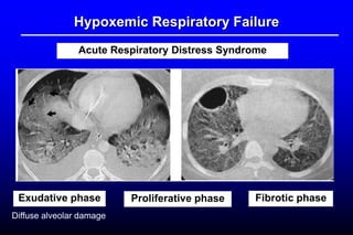 Hypoxemic Respiratory Failure
Acute Respiratory Distress Syndrome
Exudative phase Fibrotic phaseProliferative phase
Diffuse alveolar damage
 