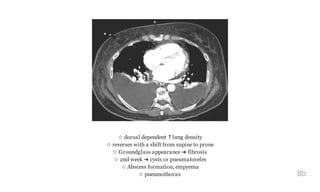 ☆ dorsal dependent ↑lung density
☆ reverses with a shift from supine to prone
☆ Groundglass appearance ➜ fibrosis
☆ 2nd week ➜ cysts or pneumatoceles
☆ Abscess formation, empyema
☆ pneumothorax 8b
 