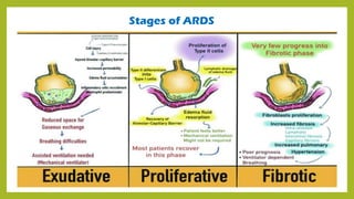 Stages of ARDS
 