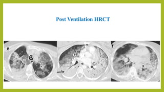 Post Ventilation HRCT
 