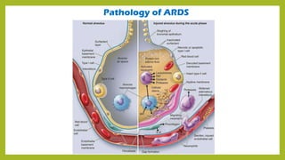 Pathology of ARDS
 