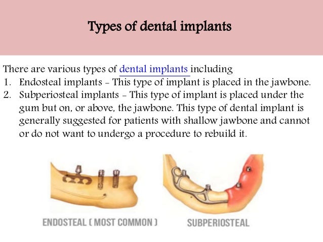 endosteal implant under fontanacountryinn com endosteal implant