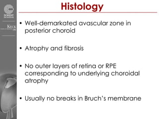 Histology Well-demarkated avascular zone in posterior choroid Atrophy and fibrosis No outer layers of retina or RPE corresponding to underlying choroidal atrophy Usually no breaks in Bruch’s membrane  