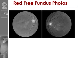 Red Free Fundus Photos 