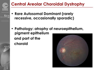 Central Areolar Choroidal Dystrophy   Rare Autosomal Dominant (rarely recessive, occasionally sporadic) Pathology: atrophy of neuroepithelium, pigment epithelium  and part of the  choroid 