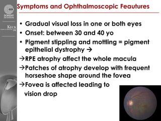 Symptoms and Ophthalmoscopic Feautures Gradual visual loss in one or both eyes Onset: between 30 and 40 yo Pigment stippling and mottling = pigment epithelial dystrophy     RPE atrophy affect the whole macula  Patches of atrophy develop with frequent horseshoe shape around the fovea Fovea is affected leading to  vision drop 